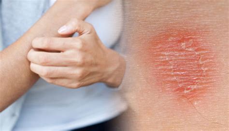 5 Home Remedies To Treat Skin Irritation During Summer
