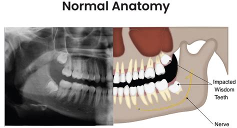 Wisdom Teeth Removal Wisdom Tooth Extraction Recovery Impacted