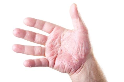 El Eczema En Las Manos Y Dedos Ducray
