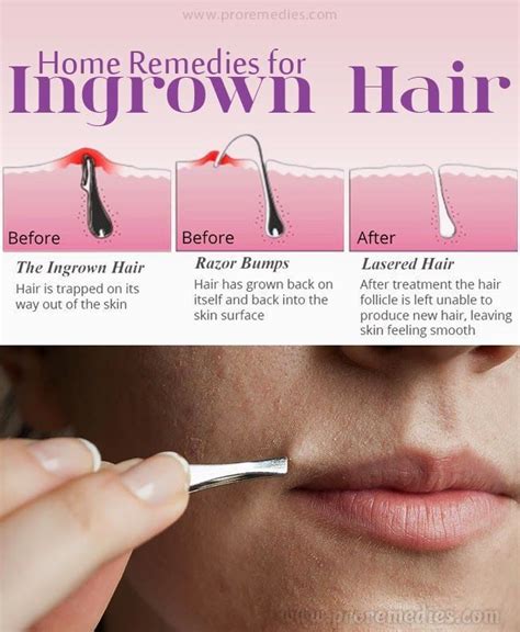 To trim it, gently pull the hair up, away from your body and then cut it back with small, sharp scissors, preferably clippers, along with some equipped with safety guards. How to Properly Remove Ingrown Hair ? in 2020 | Ingrown ...