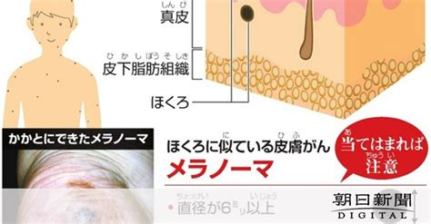 ほくろはなぜできる？ 皮膚がん「メラノーマ」にも注意：朝日新聞デジタル