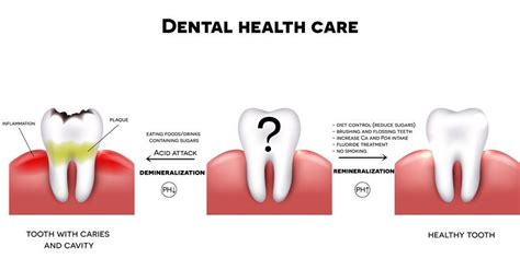 How Do You Get Cavities Cavity Tooth Decay Prevent Cavities