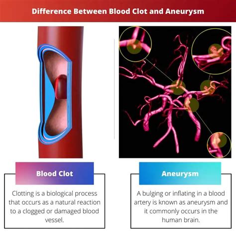 Difference Between Blood Clot And Aneurysm