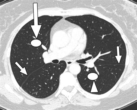 Ct Guided Percutaneous Needle Biopsy Of The Chest Preprocedural
