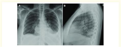 A And B Chest X Ray Transverse View Showing Cardiomegaly And Upper