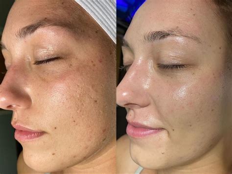 Facials Before And After Photo Gallery Chico Yuba City Oroville CA Hodari MD