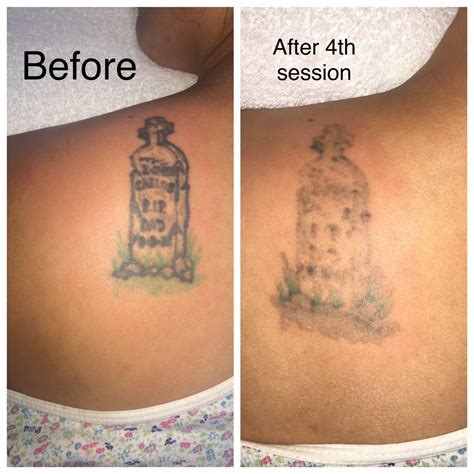 Cost of a tattoo removal it is common for people to regret after their tattoo has been done. Tattoo Be Gone SF - 80 Photos & 124 Reviews - Tattoo Removal - 126 Post St Second Fl, Union ...