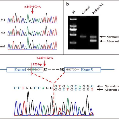 Mutation Analysis For Patient A A Splicing Mutation C G A