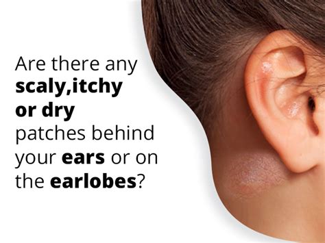 Eczema On Ear How To Get Rid Of Itchy Or Dry Ear Eczema Dry Skin