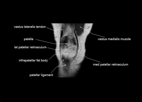 The journal of musculoskeletal medicine. knee anatomy | MRI knee coronal anatomy | free cross sectional anatomy