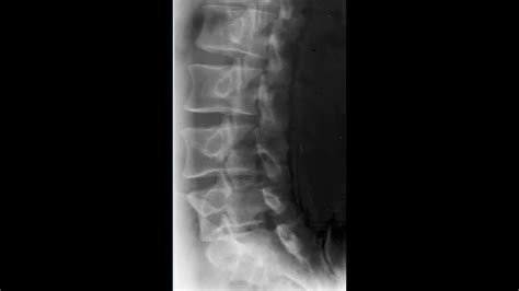 Lumbar Spine Oblique Radiology Tutorial Youtube