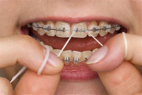 How To Floss With Braces On News Dentagama
