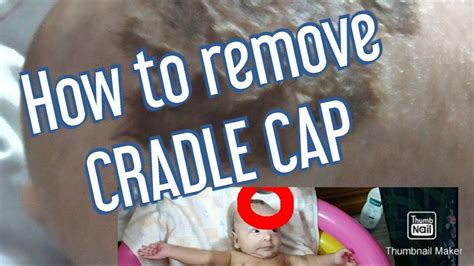 How To Get Rid Of Cradle Cap Home Remedies For Treating Cradle Cap