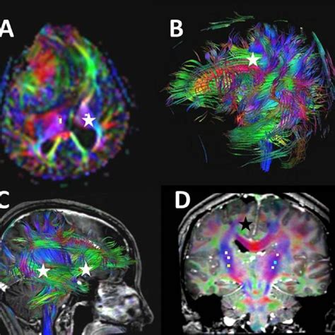 Mri And Diffusion Tensor Imaging Dti For One Of The Studied Patients