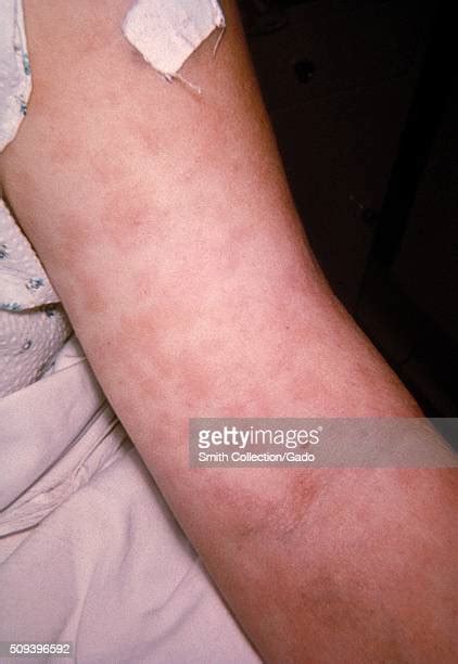 Penicillin Skin Photos And Premium High Res Pictures Getty Images