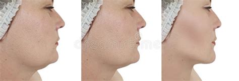 Woman Double Chin Lift Before And After Correction Procedures Stock
