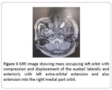 Primary Ethmoidal Sinus Extra Nodal Lymphoma A Rare Case Insight