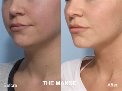 Double Chin Injections In Sydney The Manse Clinic