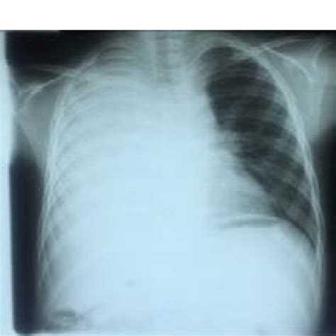 Chest Radiograph Showing A Homogeneous Opacity In The Right Lung Chest