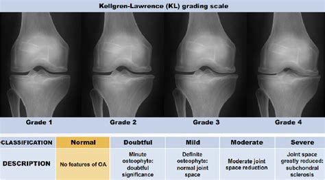 Figure 2 From Quantifying Radiographic Knee Osteoarthritis Severity