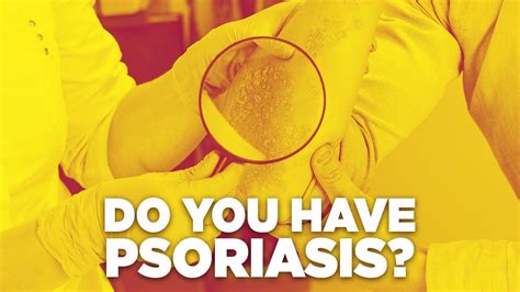 Video Do You Have Psoriasis Types Of Psoriasis Symptoms Of