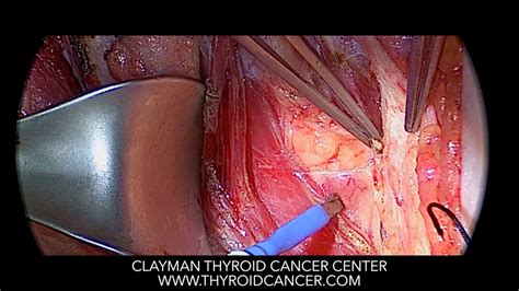 Thyroid Cancer Spread To Lymph Nodes