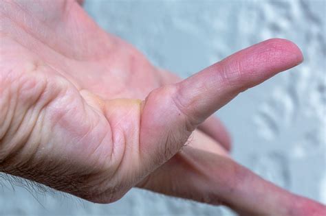 Dupuytrens Contracture Vs Trigger Finger Arora Hand Surgery