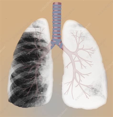 Bronchus Cancer Illustration Stock Image C0278131 Science Photo