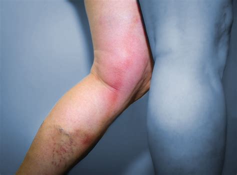 Neben spannungsgefühlen und schmerzen in den beinen, können auch optische warnsignale eine thrombose ankündigen. Blutplättchen: Wie gefährliche Thrombosen entstehen