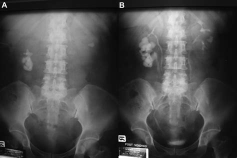 A Double Collecting System Of Right Kidney With Staghorn Calculi In