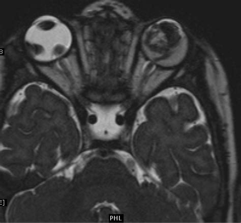 Retinoblastoma Mri Sumers Radiology Blog