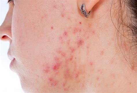 What Are The Most Common Causes Of Facial Rashes