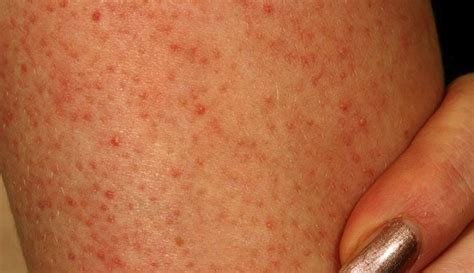 Skin Care Routine For Keratosis Pilaris Beauty And Health