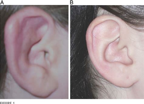 Figure 1 From Lyme Chondritis Presenting As Painless Ear Erythema