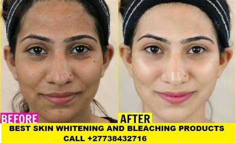 Permanent Skin Lightening Skin Whitening Products 27738432716