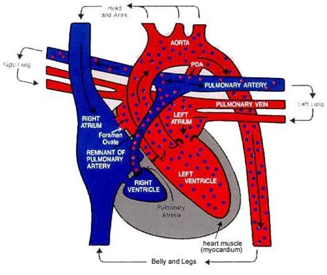 Hypoplastic Right Heart Syndrome Chd Awareness Congenital Heart