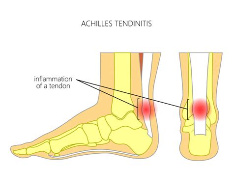 Physio For Archilles Tendonitis Toronto Vaughan Simply Align Rehab
