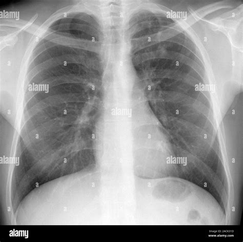Tuberculosis X Ray Of The Chest Of A 33 Year Old Male Patient With