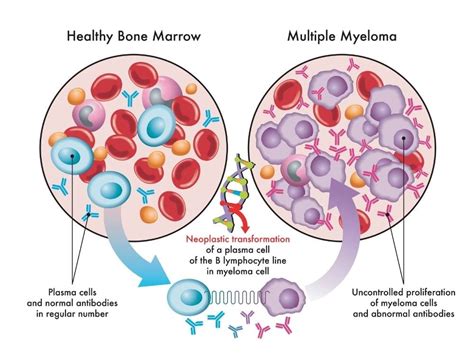 Multiple Myeloma Oncologists In The Willamette Valley Oregon