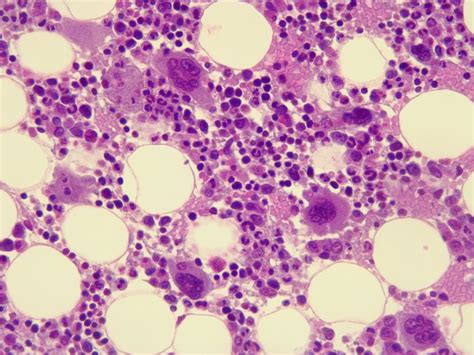 Momelotinib Performs Well At Phase Iii In Rare Bone Marrow Cancer