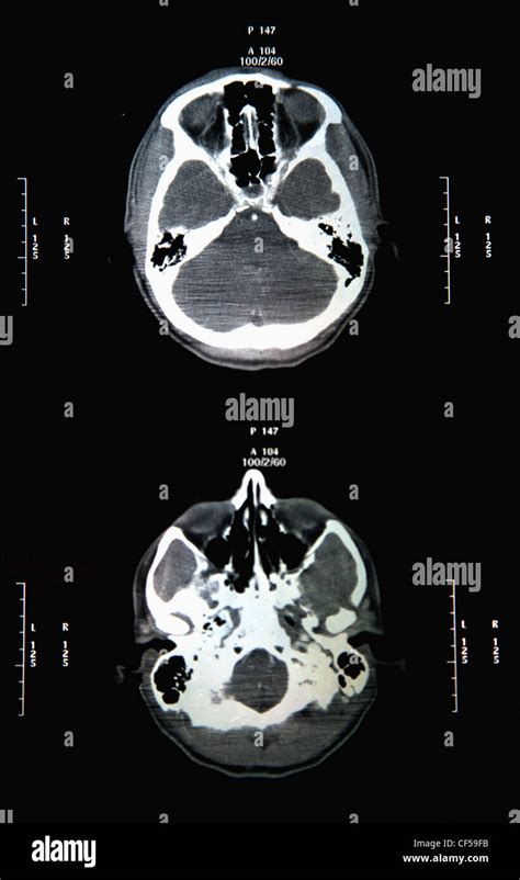 Ct Scan Report Of Head And Skull Close Up Stock Photo Alamy