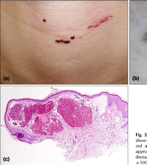 Figure 2 From Dermoscopy A Useful Tool For The Diagnosis Of