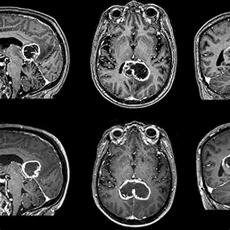 Abnormal Brain Mri Tumour Glioblastoma Multiforme Radiology Imaging