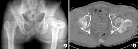 A Anteroposterior Hip Radiograph Shows Left Femoral Head Fracture And