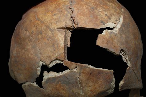 Clues To Bronze Age Cranial Surgery Revealed In Ancient Bones Npr