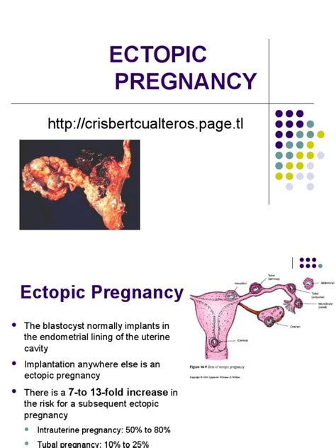 Ectopic Pregnancy5 Pdf Miscarriage Pregnancy