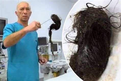 Surgeons Remove Kilo Of Hair From Girls Stomach In Kazakhastan Daily Star