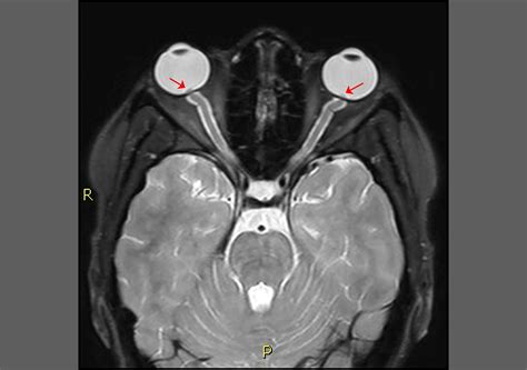 A High Pressure Situation Idiopathic Intracranial Hypertension