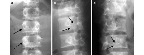 Atypical Isthmic Spondylolysis 28 Year Old Male With Back Pain Plain