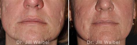 Acne Scar Treatment Before And After Pictures In Miami Fl